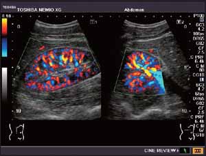 Nieren Ultraschall Bild